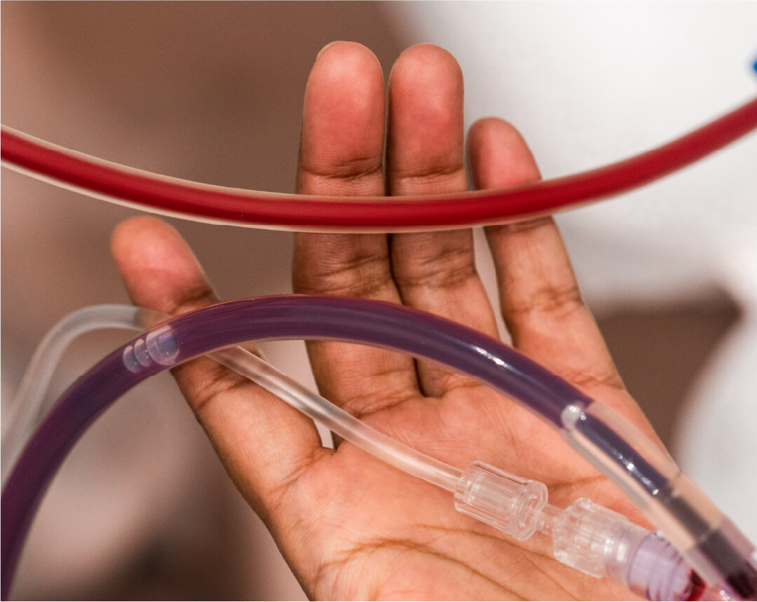 EBOO therapy session showing blood ozonation and medical detox process