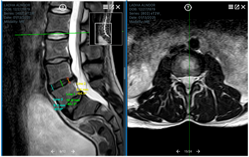 Insights Into Intervertebral Disc Degeneration and Emerging Research on the SONG Laser Protocol